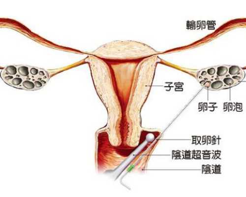 北京东方医院生殖科做一次无痛输卵管造影多少钱？