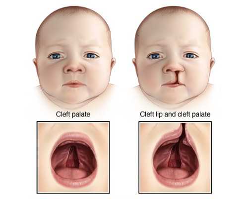 宫外孕后如何备孕的注意事项