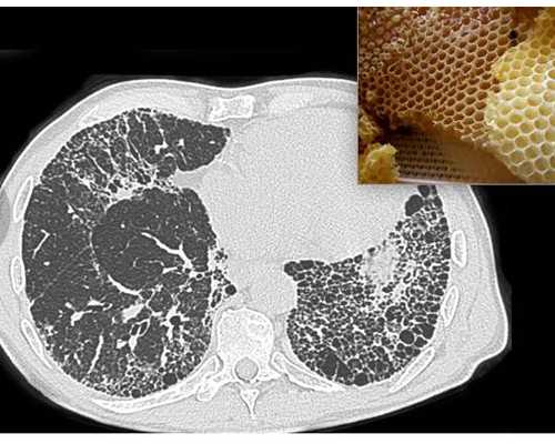 45岁高龄供卵试管一次成功经验