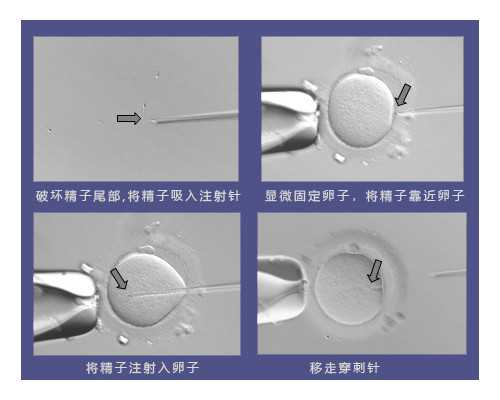 合肥正规供卵试管机构排名