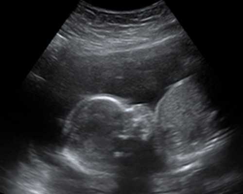 试管助孕如何降低胎儿畸形率？